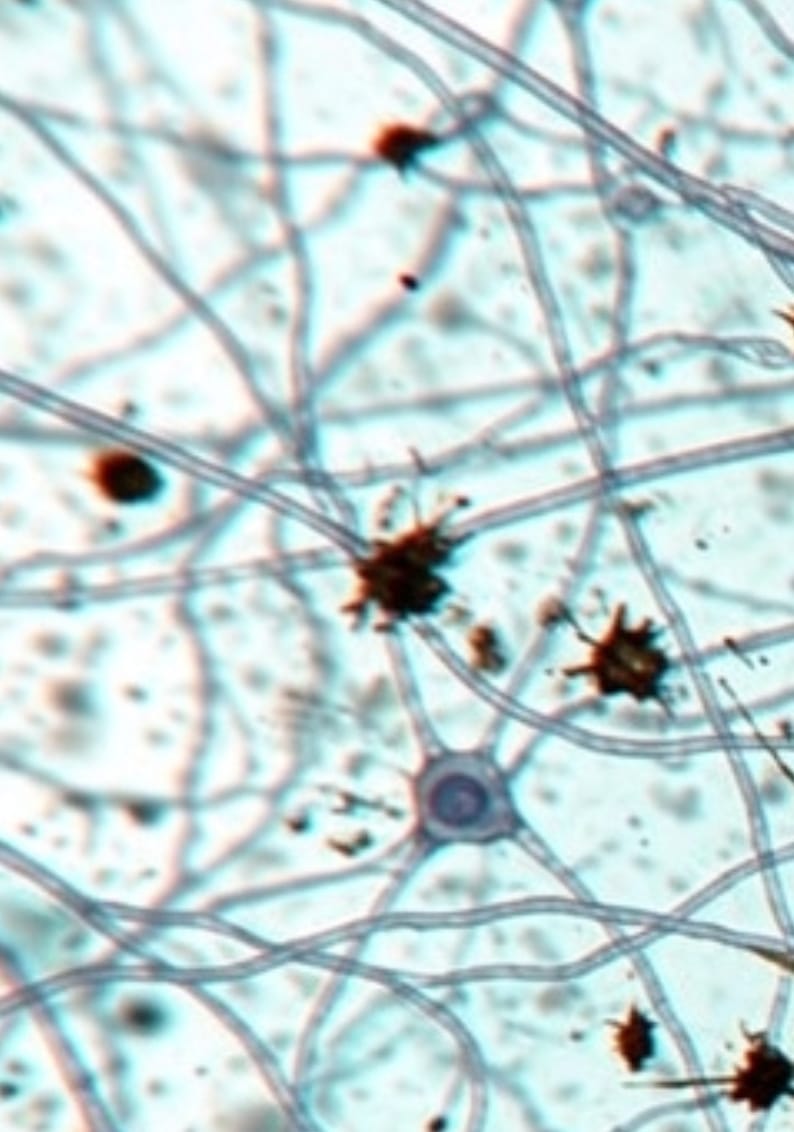 ¿Puede un simple análisis de sangre revolucionar el diagnóstico de la enfermedad de Alzheimer?